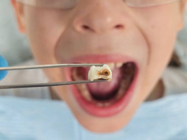 Best Emergency Treatment for Toothache in Paris, TN